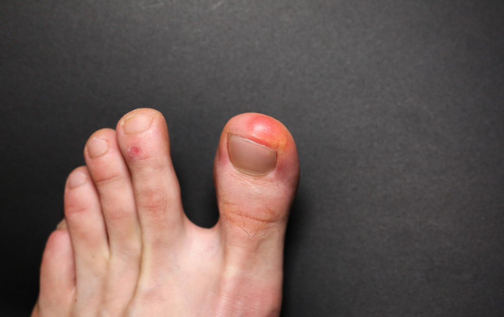 Diabetic Foot and Wound Care